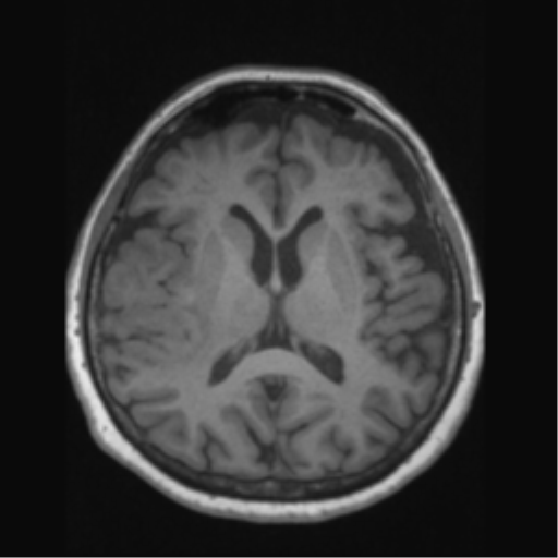 Anaplastic astrocytoma IDH wild-type (pseudoprogression) (Radiopaedia 42209-45276 Axial T1 86).png