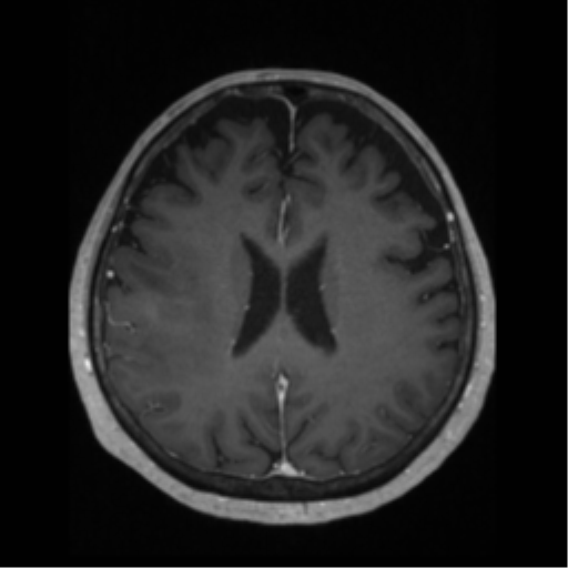 File:Anaplastic astrocytoma IDH wild-type (pseudoprogression) (Radiopaedia 42209-45276 Axial T1 C+ 94).png