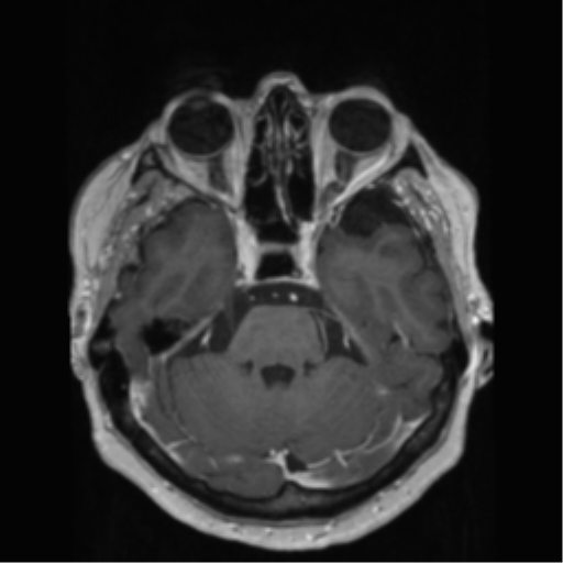File:Anaplastic astrocytoma IDH wild-type (pseudoprogression) (Radiopaedia 42209-45278 Axial T1 C+ 56).png