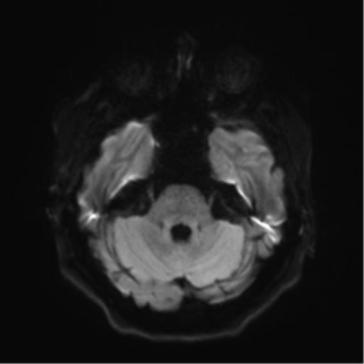 Anaplastic astrocytoma IDH wild-type (pseudoprogression) (Radiopaedia 42209-45279 Axial DWI 35).png
