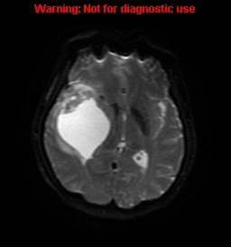 File:Anaplastic ganglioglioma (Radiopaedia 44921-48831 Axial DWI 46).jpg