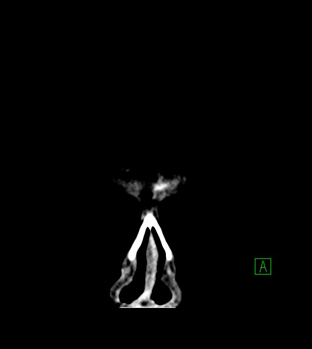 Anaplastic oligodendroglioma (Radiopaedia 79571-92758 Coronal non-contrast 4).jpg