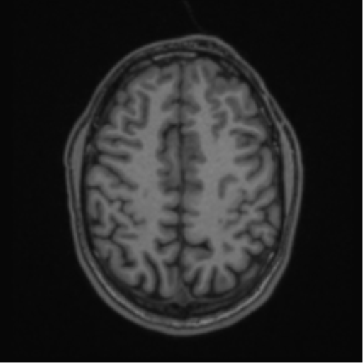 Anaplastic oligodendroglioma with skull fracture (Radiopaedia 74831-85845 Axial T1 49).png
