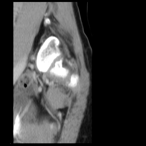 File:Aneurysmal bone cyst - sacrum (Radiopaedia 65190-74195 A 4).jpg
