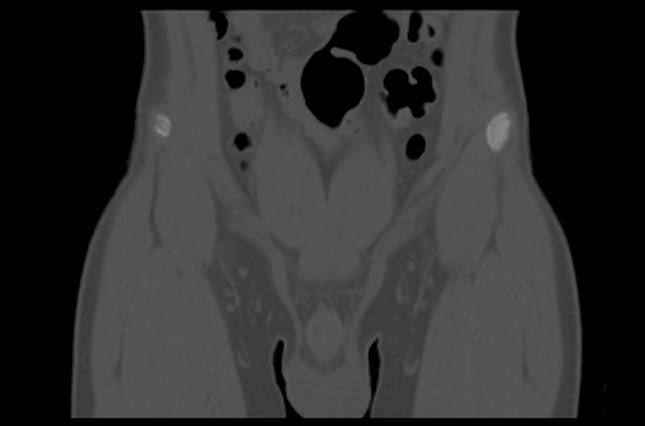 File:Aneurysmal bone cyst of ischium (Radiopaedia 25957-26094 Coronal bone window 3).png