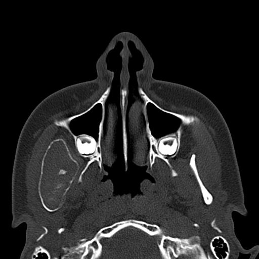 Aneurysmal bone cyst of the mandible (Radiopaedia 43280-46601 Axial bone window 61).jpg