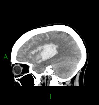 File:Aneurysmal subarachnoid hemorrhage with intra-axial extension (Radiopaedia 84371-99699 B 15).jpg