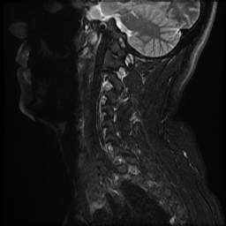 File:Ankylosing spondylitis - shiny corner sign (Radiopaedia 52084-57939 Sagittal T2 24).jpg