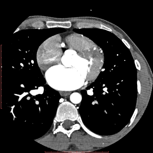 Anomalous left coronary artery from the pulmonary artery (ALCAPA) (Radiopaedia 70148-80181 A 162).jpg