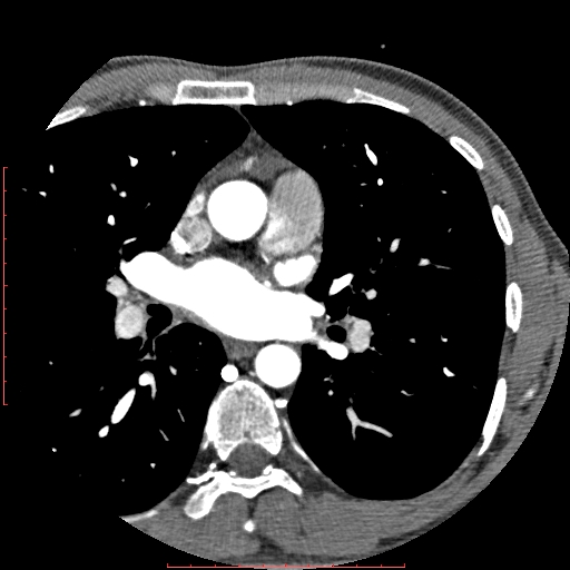 File:Anomalous left coronary artery from the pulmonary artery (ALCAPA) (Radiopaedia 70148-80181 A 51).jpg