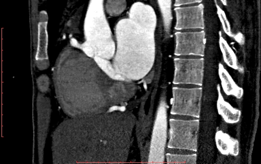Anomalous left coronary artery from the pulmonary artery (ALCAPA) (Radiopaedia 70148-80181 C 112).jpg