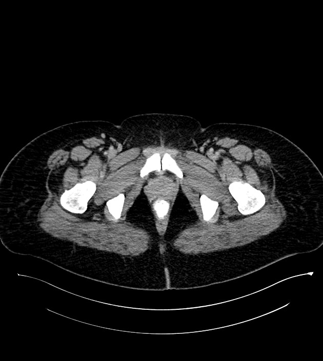 Anterior abdominal wall CSF pseudocyst (CSFoma) (Radiopaedia 79453-92571 A 94).jpg