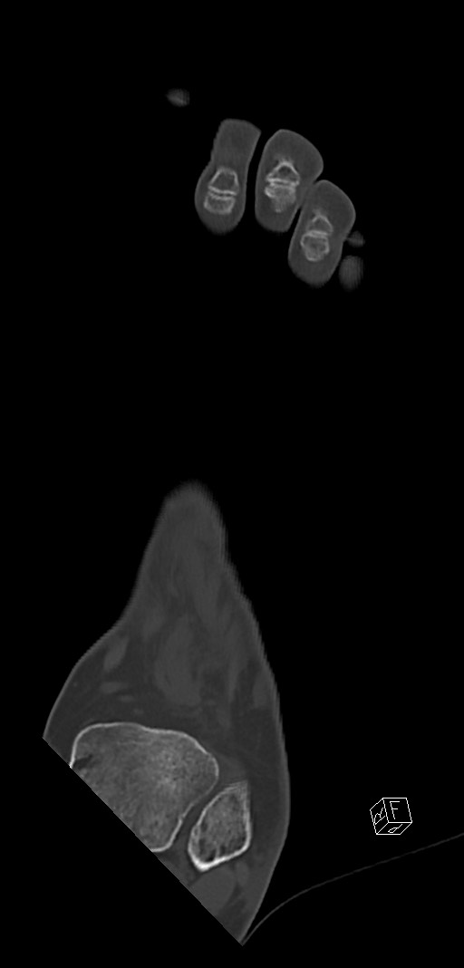 Anterior calcaneal process fracture (Radiopaedia 63353-71943 Coronal bone window 11).jpg