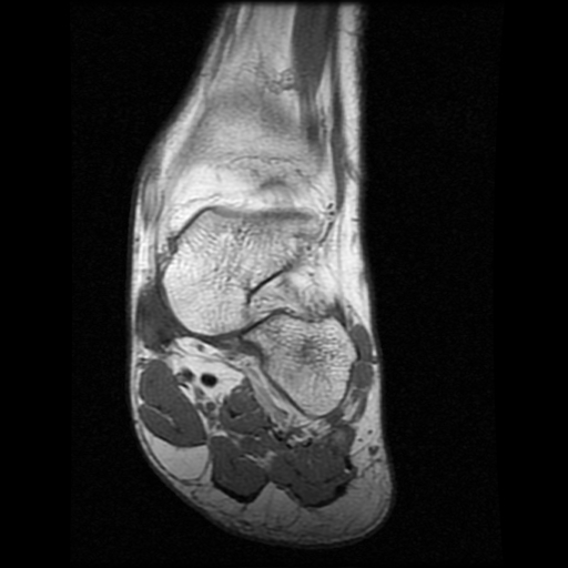 File:Anterior calcaneal process fracture (Radiopaedia 74654-85611 Coronal T1 7).jpg