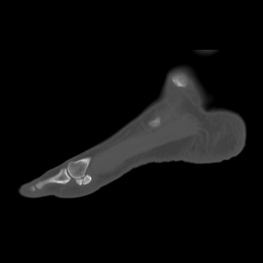 File:Anterior calcaneal process fracture (Radiopaedia 82590-96762 Sagittal bone window 5).jpg
