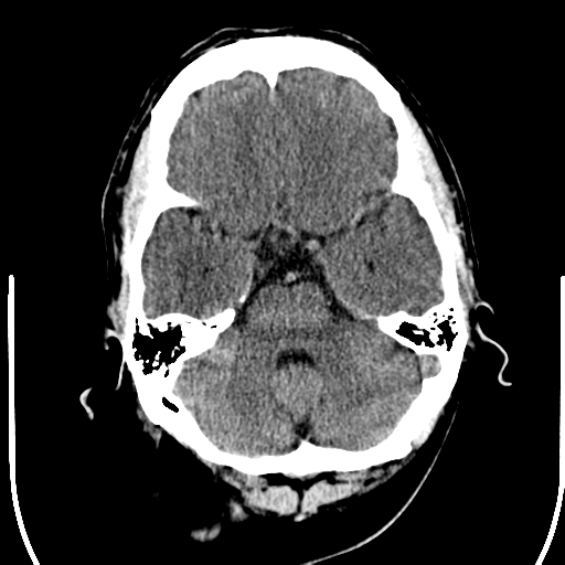 File:Anterior cerebral artery territory infarct (Radiopaedia 39327-41581 Axial non-contrast 8).png