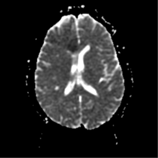 File:Anterior cerebral artery territory infarct (Radiopaedia 39327-41584 Axial ADC 15).png