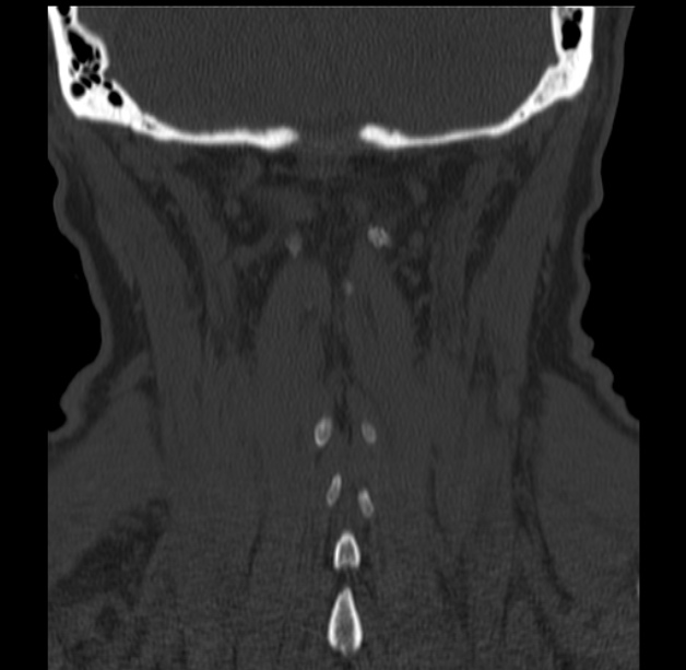Anterior cervical postdiscectomy arthrodesis (Radiopaedia 32678-33646 Coronal bone window 59).jpg