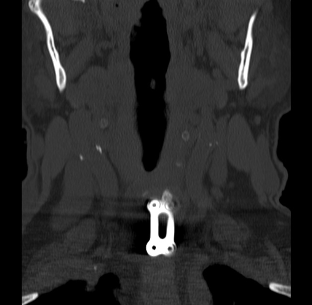Anterior cervical postdiscectomy arthrodesis (Radiopaedia 32678-33646 Coronal bone window 9).jpg