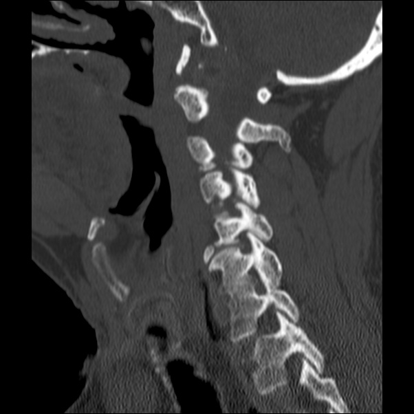 Anterior cervical postdiscectomy arthrodesis (Radiopaedia 32678-33646 Sagittal bone window 27).jpg