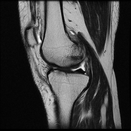 File:Anterior cruciate ligament avulsion fracture (Radiopaedia 58939-66193 Sagittal T2 14).jpg