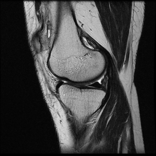 File:Anterior cruciate ligament avulsion fracture (Radiopaedia 58939-66193 Sagittal T2 15).jpg