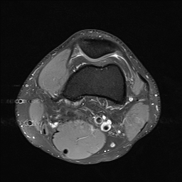 File:Anterior cruciate ligament full thickness tear (Radiopaedia 66268-75467 Axial PD fat sat 6).jpg