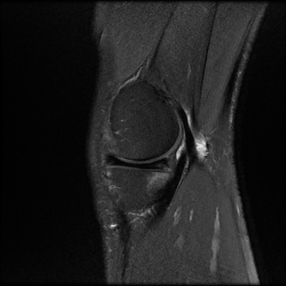File:Anterior cruciate ligament graft tear and bucket-handle tear of medial meniscus (Radiopaedia 75867-87254 Sagittal PD fat sat 6).jpg