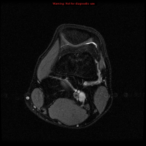 File:Anterior cruciate ligament injury - partial thickness tear (Radiopaedia 12176-12515 Axial PD 6).jpg