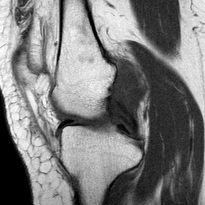 Anterior cruciate ligament mucoid degeneration (Radiopaedia 60853-68633 Sagittal T1 12).jpg