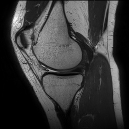 Anterior cruciate ligament rupture and posteromedial corner injury (Radiopaedia 67338-76723 Sagittal PD 60).jpg