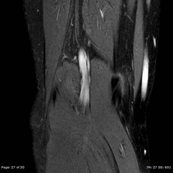 File:Anterior cruciate ligament tear (Radiopaedia 70783-80964 Coronal STIR 27).jpg