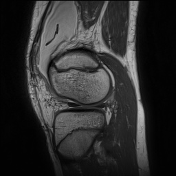Anterior cruciate ligament tear - pediatric (Radiopaedia 62152-70260 Sagittal PD 131).jpg