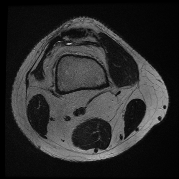 File:Anterior cruciate ligament tear with posteromedial corner injury, bucket-handle meniscal tear and chondral delamination (Radiopaedia 75501-86744 Axial T2 25).jpg