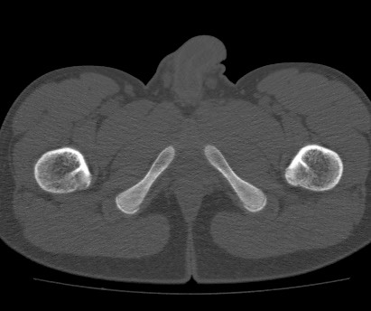 Anterior inferior iliac spine avulsion fracture (Radiopaedia 81312-94999 Axial bone window 71).jpg