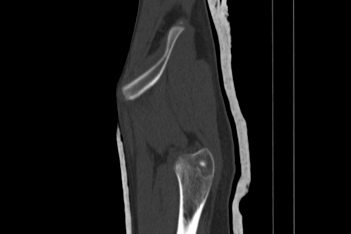 Anterior inferior iliac spine avulsion injury (Radiopaedia 88666-105376 Sagittal bone window 16).jpg