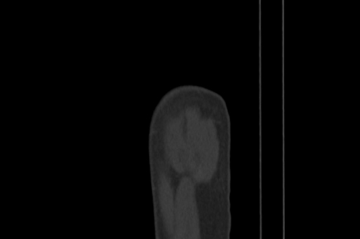 Anterior inferior iliac spine avulsion injury (Radiopaedia 88666-105376 Sagittal bone window 97).jpg