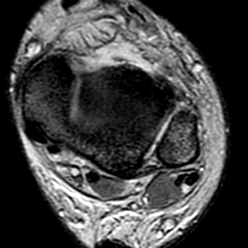 File:Anterior talofibular ligament rupture (Radiopaedia 15831-15484 Axial T2* 6).jpg