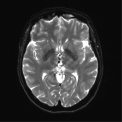 Anterior temporal lobe perivascular space (Radiopaedia 40946-43650 Axial DWI 13).png