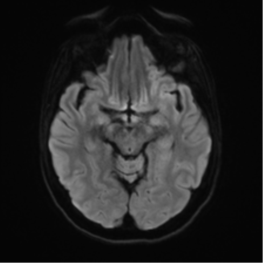 Anterior temporal lobe perivascular space (Radiopaedia 40946-43650 Axial DWI 38).png