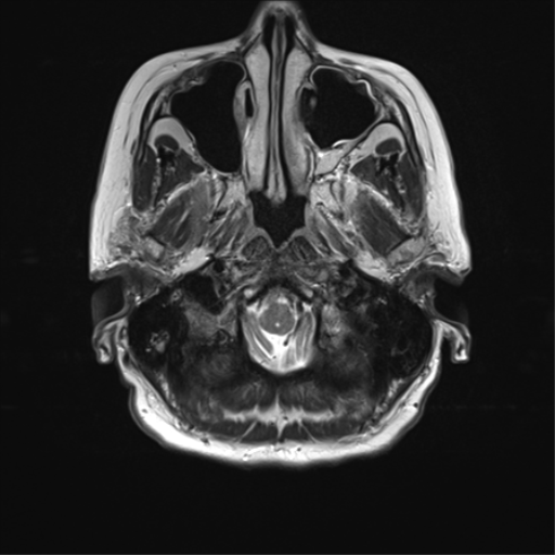 File:Anterior temporal pole cysts (Radiopaedia 46629-51102 C 5).png