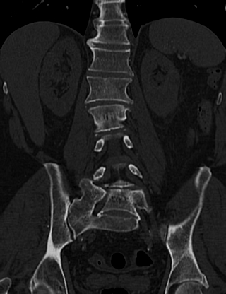 Anterior vertebral scalloping (abdominal aortic aneurysm) (Radiopaedia 66744-76067 Coronal bone window 42).jpg