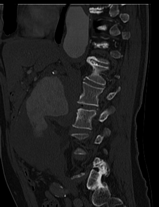 File:Anterior vertebral scalloping (abdominal aortic aneurysm) (Radiopaedia 66744-76067 Sagittal bone window 12).jpg