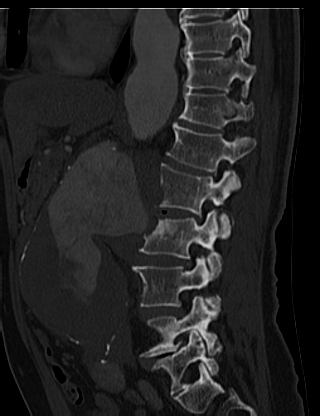File:Anterior vertebral scalloping (abdominal aortic aneurysm) (Radiopaedia 66744-76067 Sagittal bone window 20).jpg