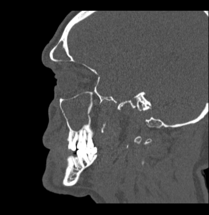 Antrochoanal polyp (Radiopaedia 79011-92169 Sagittal bone window 59).jpg