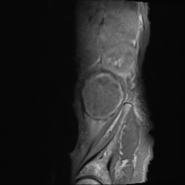 File:Aortic aneurysm with spinal destruction (Radiopaedia 42301-45409 Sagittal T1 fat sat 7).jpg