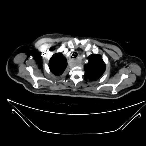 Aortic arch aneurysm (Radiopaedia 84109-99365 C 9).jpg
