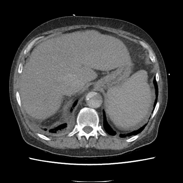 Aortic arch graft infection (FDG PET-CT) (Radiopaedia 71975-82437 A 57).jpg