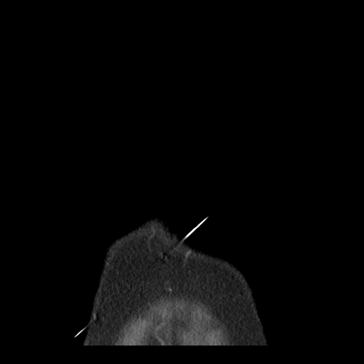 Aortic arch graft infection (FDG PET-CT) (Radiopaedia 71975-82437 Coronal 1).jpg