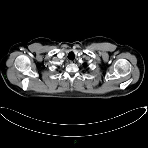 Aortic arch origin of left vertebral artery (Radiopaedia 46327-50737 Axial post contrast 10).jpg